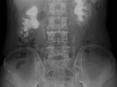 Image #1- NEJM Mycoplasma genitalium Urethritis
